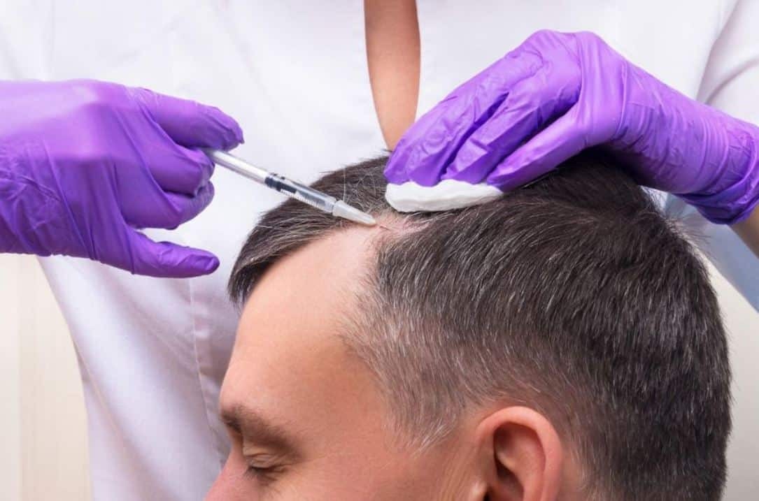 Haarausfall Nürnberg: Wie MY AESTHETICS Ihre Haut und Lippen verjüngen kann