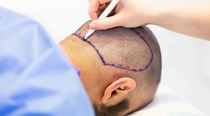 Verändern Sie Ihr Aussehen mit einer Haartransplantation: Experteneinblicke