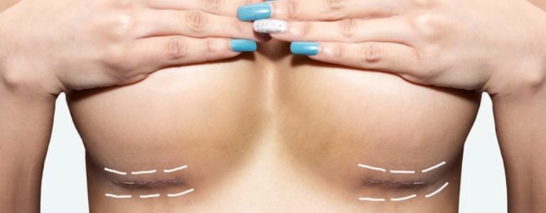 Brustverkleinerung: Was Sie vor der Operation wissen sollten